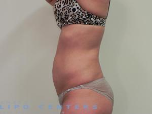 americanlipocenters_32.jpg